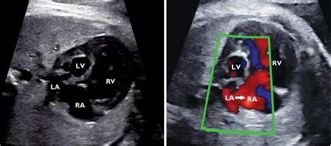 7th Meeting Fetal And Neonatal Assessment Of Hypoplastic Left Heart Syndrome Sscape