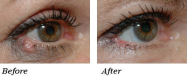 Eyelid Cancer Surgery | St. Petersburg & Clearwater | Tampa Bay ...