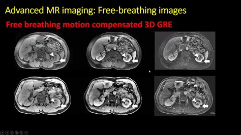 Ct And Mri Of Renal Masses Youtube