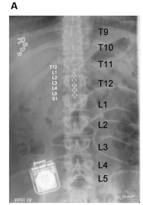 X Ray Of Electrode Array For Epidural Stimulation Uofl News