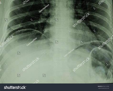 Air Under Diaphragm On Chest Xray Stock Photo 782121076 | Shutterstock