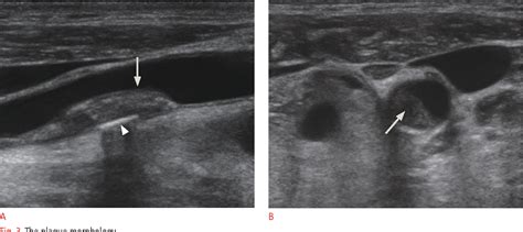 Figure 3 From General Principles Of Carotid Doppler Ultrasonography Semantic Scholar