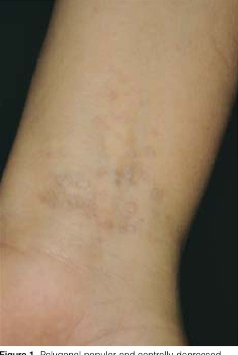 Figure From Lichen Sclerosus Et Atrophicus Affecting The Wrists And