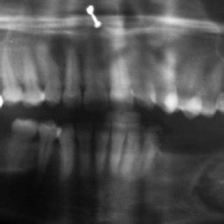 Orthopantamograph Showing A Unilocular Radiolucent Lesion Interspersed