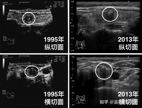 乳头状甲状腺微小癌，不做手术观察是一种什么体验？ 知乎