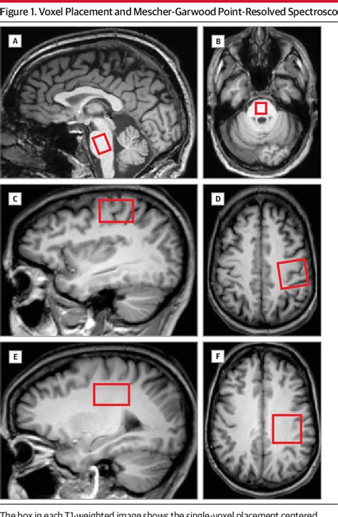 Figure 1 From An Imbalance Between Excitatory And Inhibitory