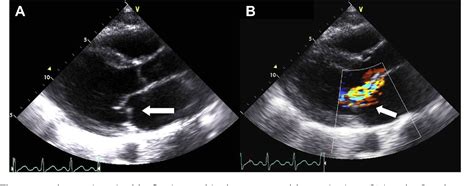 Figure 1 From Exercise Induced Acute Mitral Valve Chordae Rupture