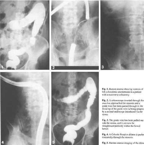 Colocolonic Anastomosis Reinforcement Of The Colon Anastomosis With