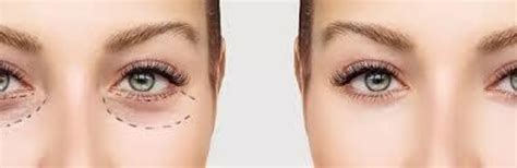 Laser Therapeutics | Eye (Lower) Lid Skin Tightening