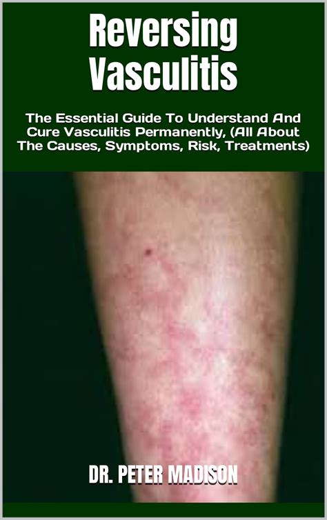 Reversing Vasculitis The Essential Guide To Understand And Cure Vasculitis Permanently By Dr