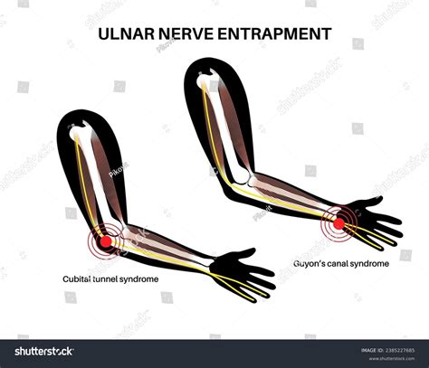 Ulnar Nerve Entrapment Cubital Tunnel Syndrome Royalty Free Stock