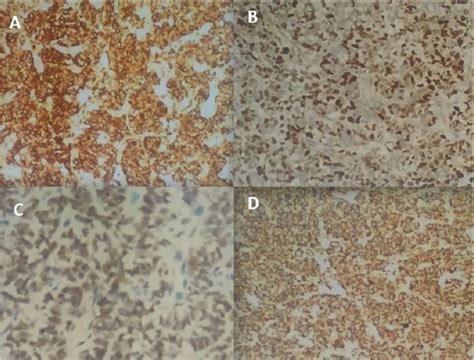 Immunohistohemical Panel Staining Positive For A Vimentin B Bcl 2