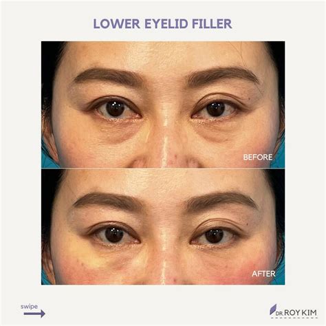 Unlocking The Secrets Of Undereye Rejuvenation Filler Or Surgery Roy Kim Md