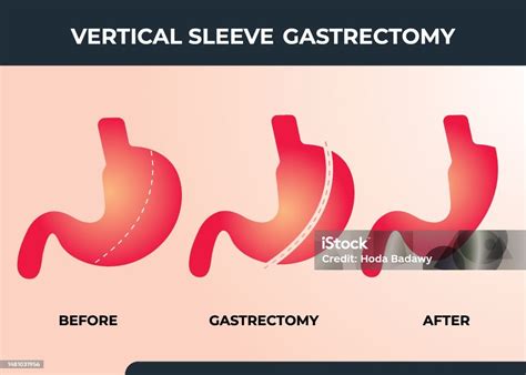 Laparoscopic Sleeve Gastrectomy Vertical Gastrectomy Weight Loss