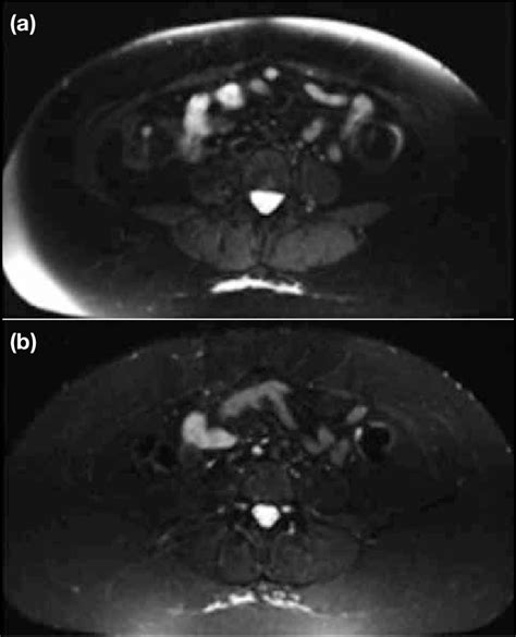 A Axial T2 Weighted Spectral Attenuated Inversion Recovery Image