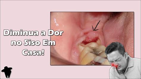 Dicas Para Diminuir A Dor No Dente Do Siso Em Casa Pericoronarite