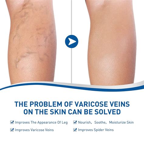 Buy Veinshealth Varicose Veins Blue Light Therapy Set Spider Vein