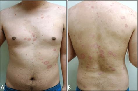 A B Paradoxical Flare Of Plaque Type Psoriasis After The Fourth Download Scientific Diagram