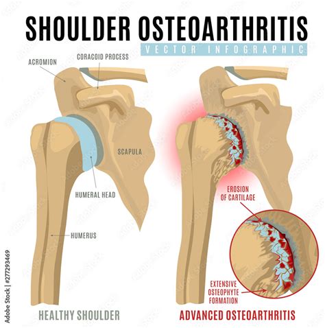 Shoulder osteoarthritis infographic Stock Vector | Adobe Stock