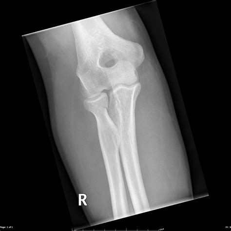 Radial Neck Fracture Image Radiopaedia Org