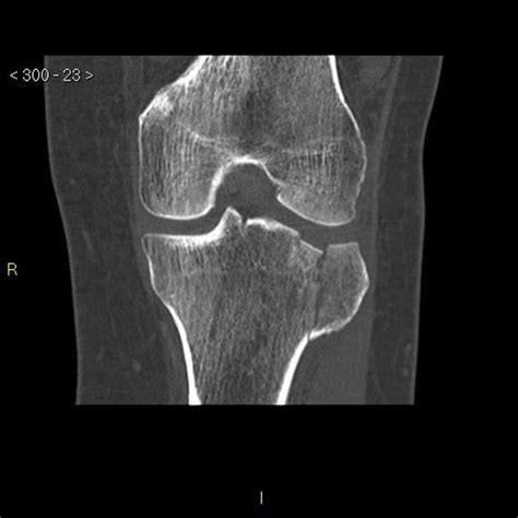 Bumper Fracture