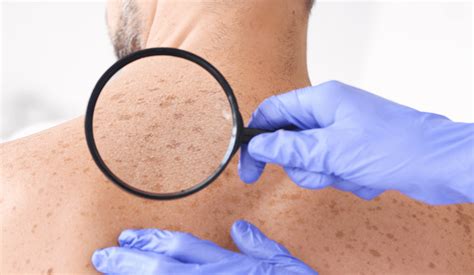 What Causes White Spots On Skin Risks And Treatments Dcsi