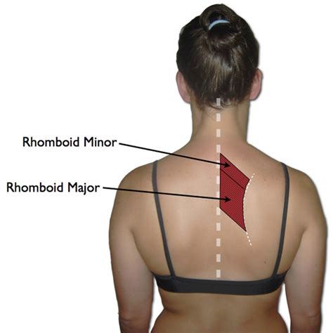 Rhomboid Trigger Points: A Pain Between the Shoulder Blades ...