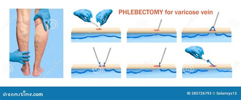 Ambulatory Phlebectomy Treatment For Varicose Vein Stock Image Image