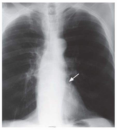 Radiography Of Acquired Heart Disease Radiology Key