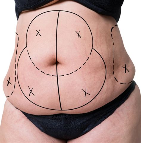 Tummy Tuck Turkey Abdominoplasty