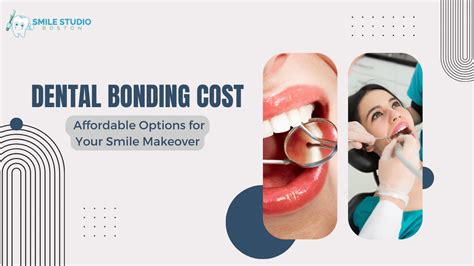 Dental Bonding Cost Affordable Options For Your Smile Makeover Smile