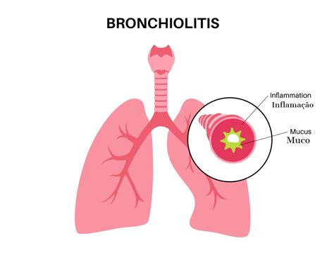 Bronquiolite o que é e como cuidar Dra Vivian Caldas