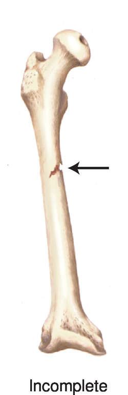 Open fracture | definition of open fracture by Medical dictionary