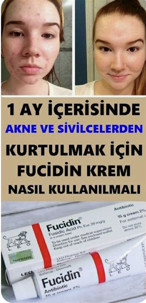 Fucidin Krem Nedir Ne E Yarar Nas L Kullan L R Yan Etkileri