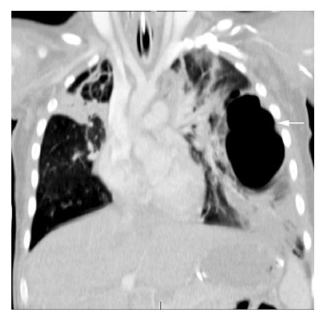 Coronal view on CT chest: a large and irregular pneumatocele extending ...