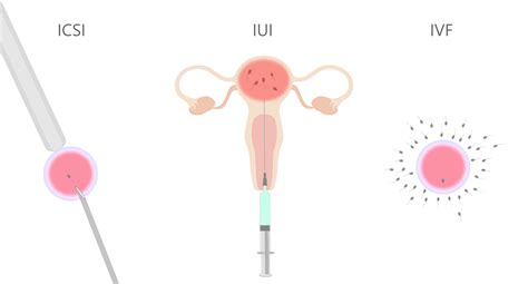 Insemination Ivf Eller ægdonation Diers Klinik