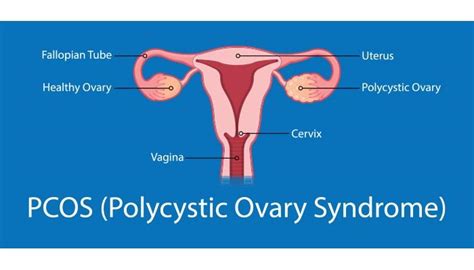 Polycystic ovary syndrome (PCOS) - Symptoms and causes