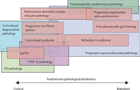 Progressive Supranuclear Palsy Clinicopathological Concepts And Diagnostic Challenges The