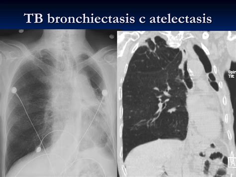 Ppt Tuberculosis What Is Essential To Know Powerpoint Presentation Id 3413206