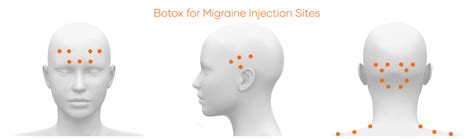 Botulinum Toxin Treatment Northwest Neurological