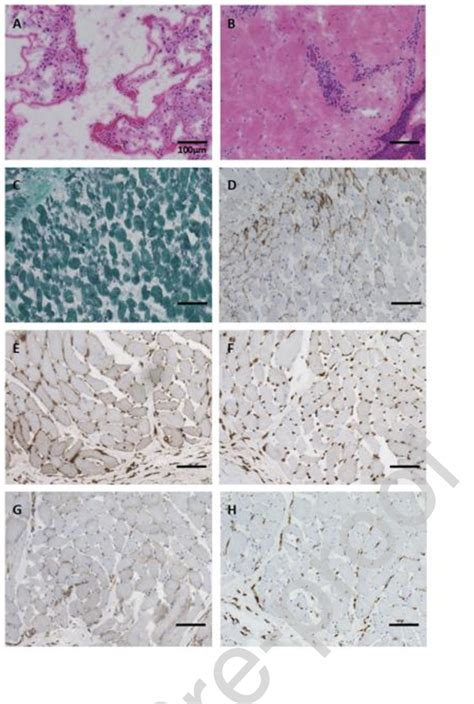 Figure From Amyopathic Mda Positive Dermatomyositis With Severe