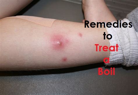 How to Treat a Boil?