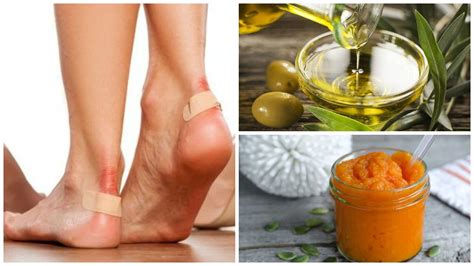 Alivia Las Ampollas De Los Pies Con Estos 7 Remedios Naturales Mejor