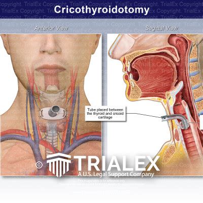 Cricothyroidotomy - TrialExhibits Inc.