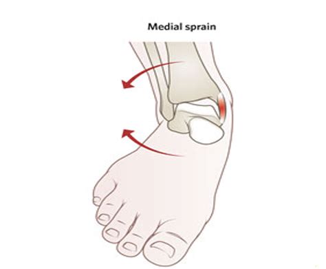 Condition Spotlight Medial Ankle Sprains Watsonia Podiatry