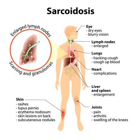 Symptoms of Sarcoidosis | VA Disability for Chronic Disease | Cuddigan Law