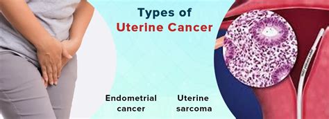 Uterine Cancer Its Symptoms Diagnosis And Treatment