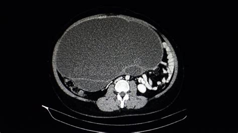 Exploraci N O Tomograf A Computacional De Todo El Abdomen De Un