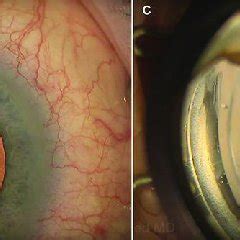 PDF Surgical Approaches For Implanting Xen Gel Stent Without