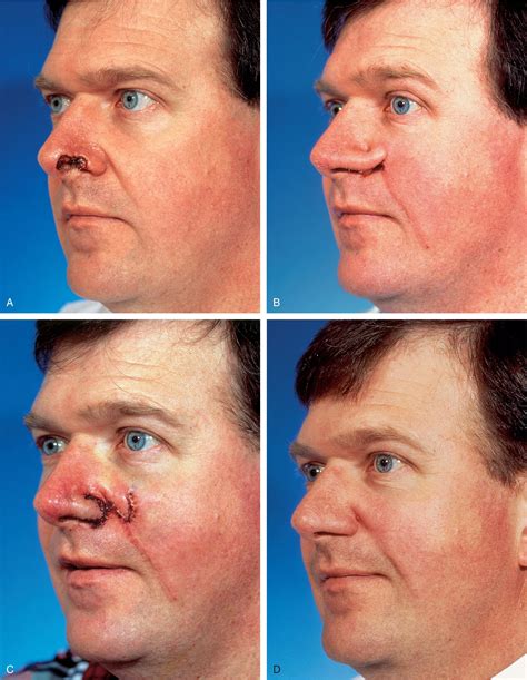 Flap Classification And Design Clinical Tree